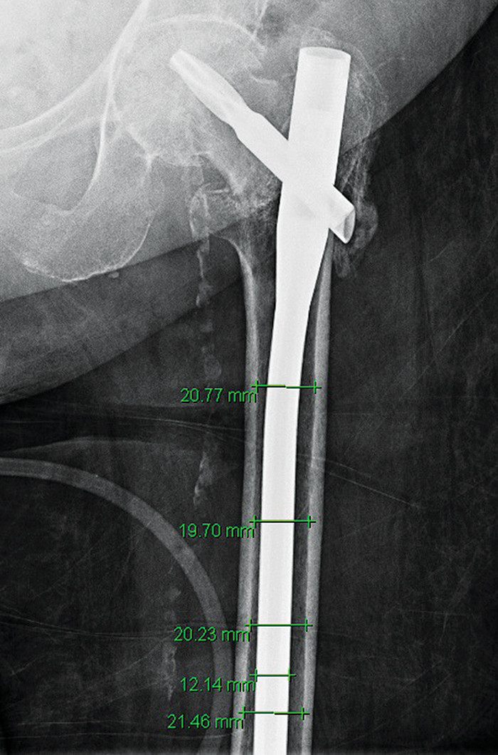 Is Distal Fixation Necessary in Cephalomedullary Fixation of  Pertrochanteric Femur Fractures?