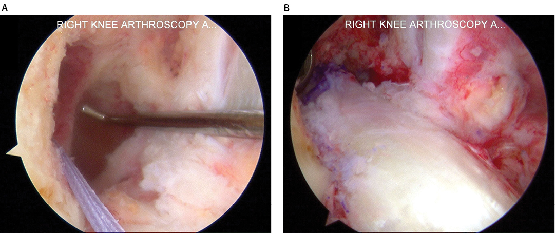 TT to AM Drilling in ACL Reconstruction  Figure 1