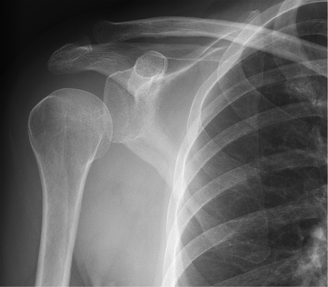 old rotator cuff injury