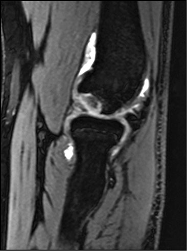 Clinical Presentation of Osteochondritis Dissecans of the Capitellum in Males and Females Figure 1