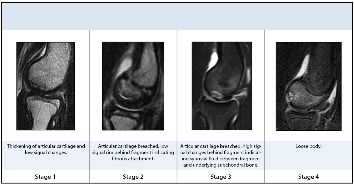 osteochondritis dissecans stages ahol a rheumatoid arthritis jobb kezelése