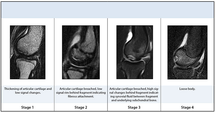Clinical Presentation of Osteochondritis Dissecans of the Capitellum in Males and Females Table 2
