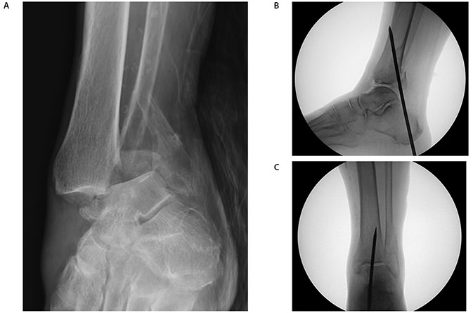 Extra-Articular Calcaneo-Tibial Schanz Pin Stabilization for Acute Ankle Trauma Figure 1