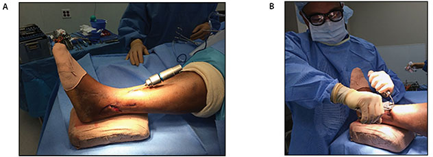 Extra-Articular Calcaneo-Tibial Schanz Pin Stabilization for Acute Ankle Trauma Figure 2