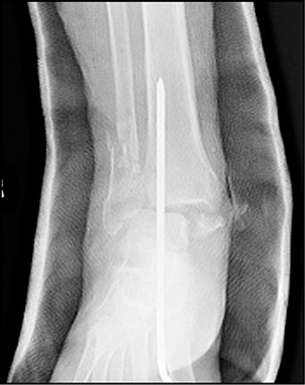 Extra-Articular Calcaneo-Tibial Schanz Pin Stabilization for Acute Ankle Trauma Figure 3