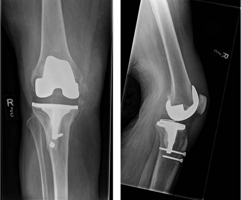 Tibial Post Fracture Figure 1