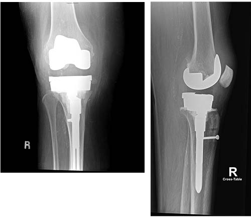Tibial Post Fracture Figure 4