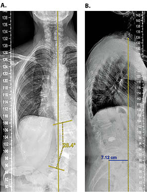 Degenerative Scoliosis Figure 1