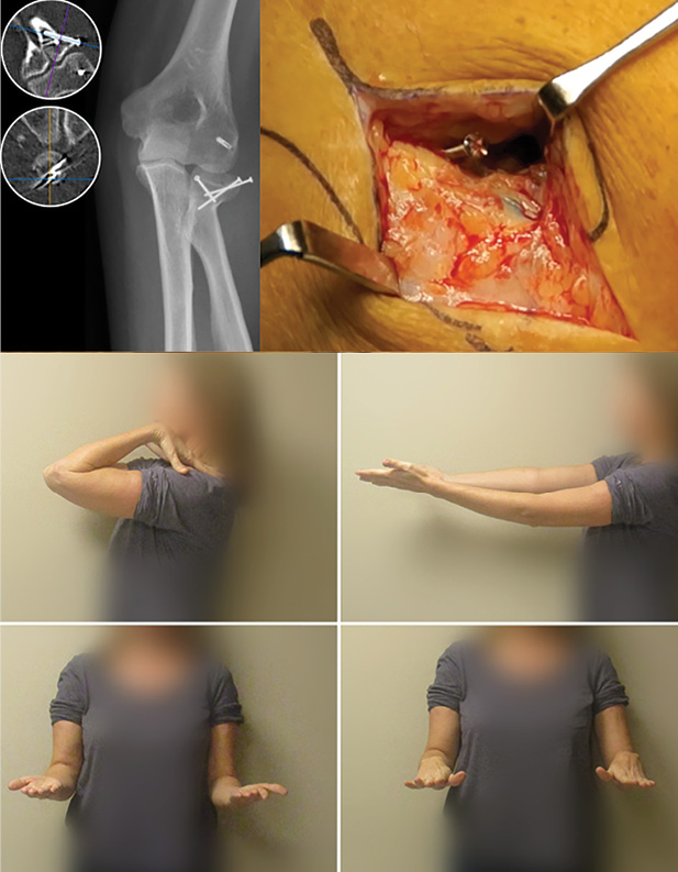 Functional and Complications of Radial Head Fractures Treated