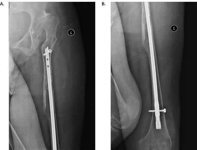 Humeral Nail Femoral Frature Figure 3