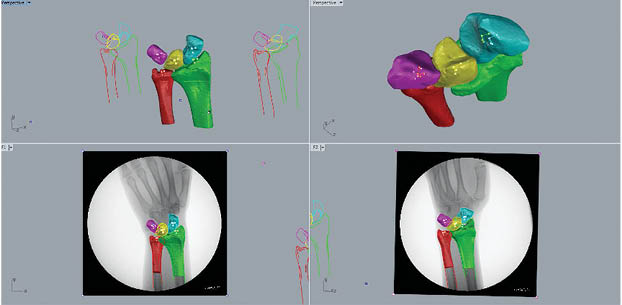 3D CT Wrist Figure 5