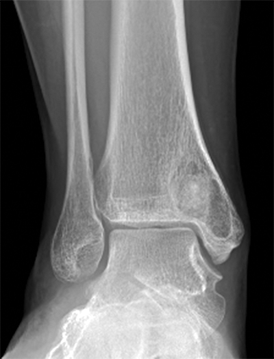 Tibial Cyst Figure 1