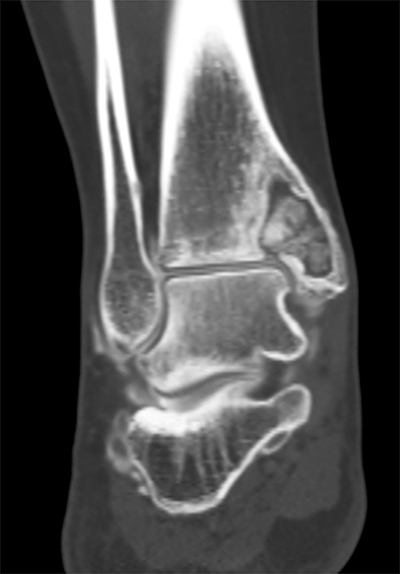 Tibial Cyst Figure 2