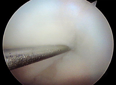 Tibial Cyst Figure 3