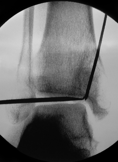 Tibial Cyst Figure 4