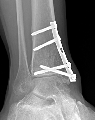 Tibial Cyst Figure 5
