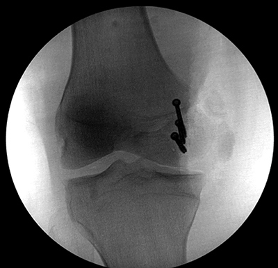 Femoral Condyle Fracture Figure 3