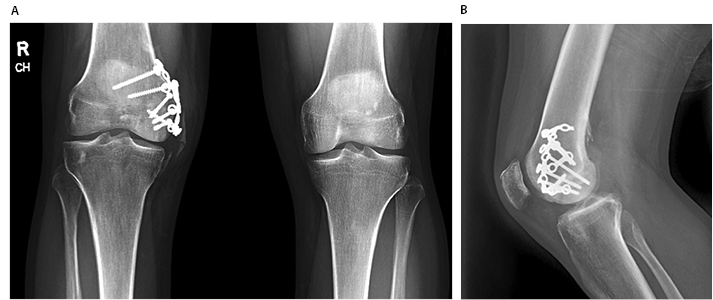 Femoral Condyle Fracture Figure 5