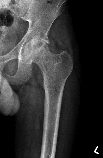 PVNS Figure 1
