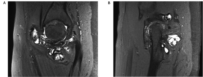 PVNS Figure 3