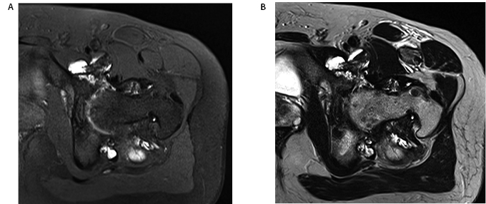 PVNS Figure 4