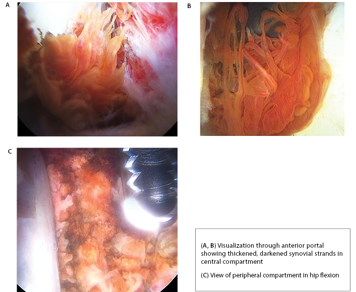 PVNS Figure 5