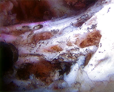 PVNS Figure 6
