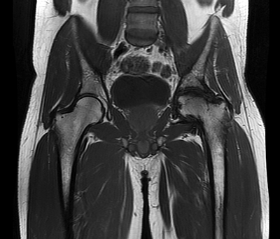 PVNS Figure 7
