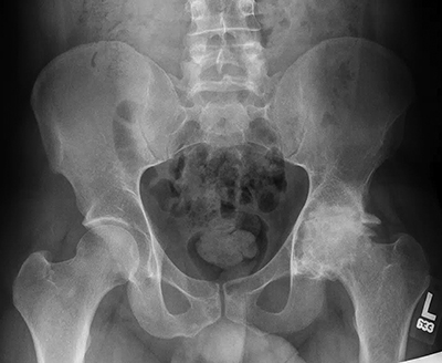 PVNS Figure 8