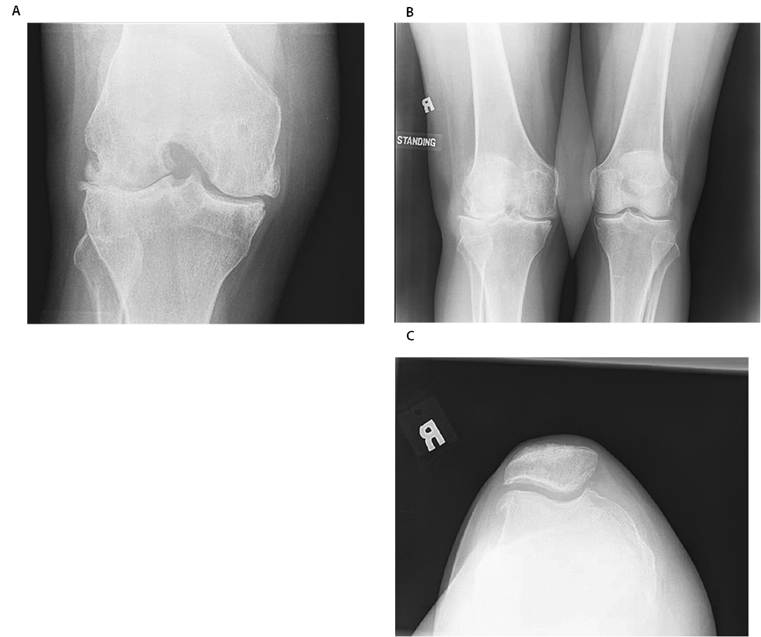 Atraumatic Late Screw Loosening Figure 1