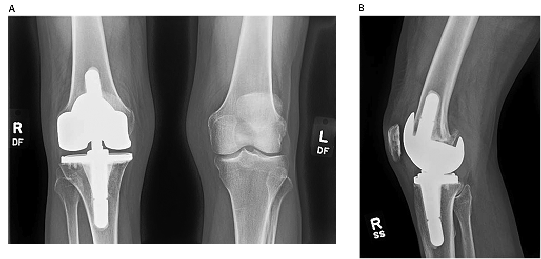 Atraumatic Screw Loosening Figure 2