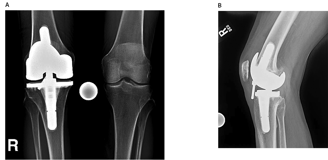 Atraumatic Screw Loosening Figure 3