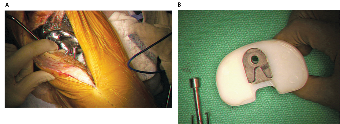 Atraumatic Screw Loosening Figure 4