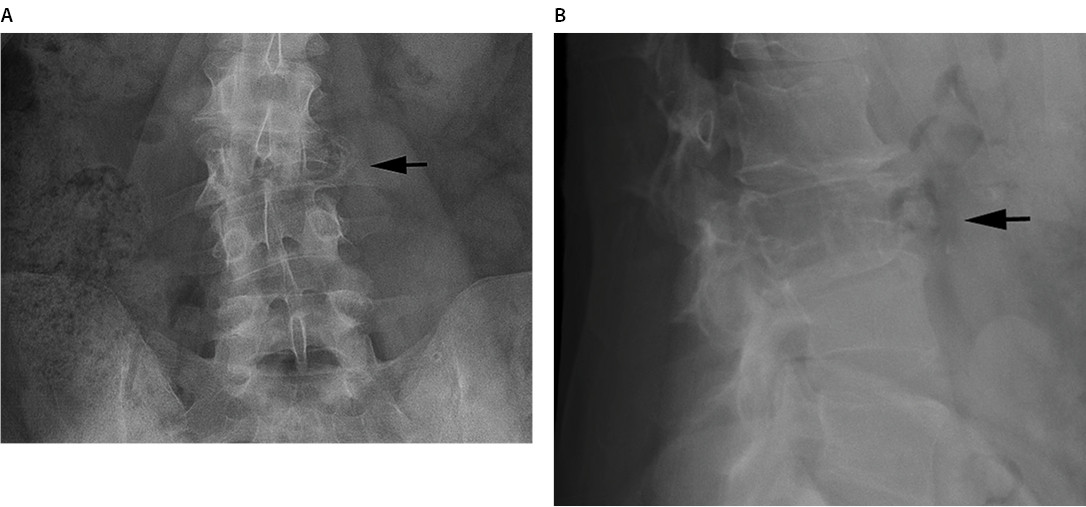 Plasmacytoma of the Lumbar Spine Figure 1