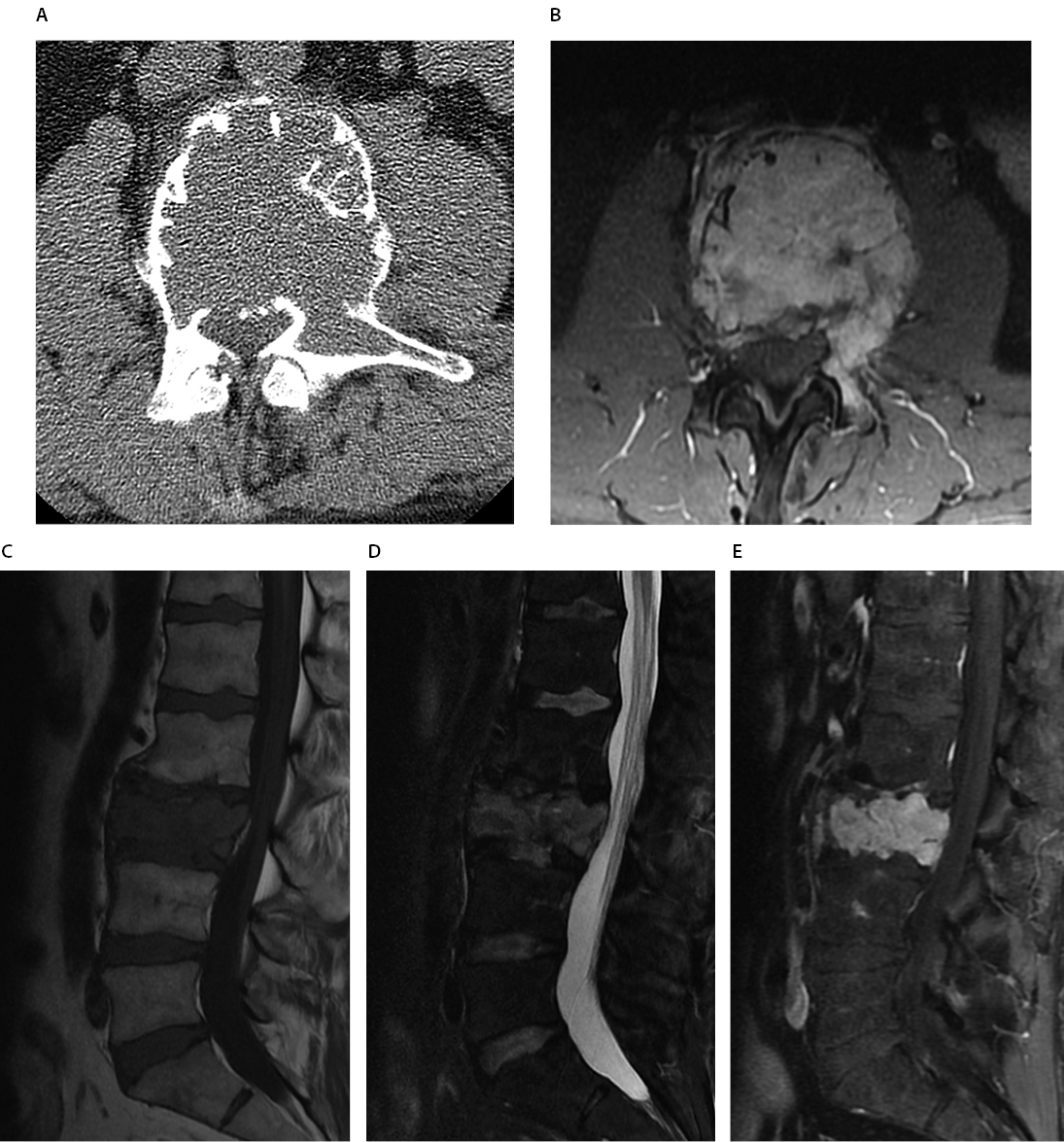 Plasmacytoma of the Lumbar Spine Figure 2