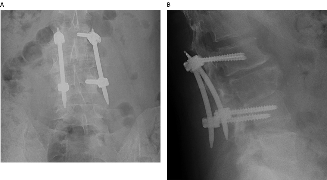 Plasmacytoma of the Lumbar Spine Figure 2