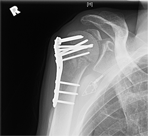Bilateral Posterior Shoulder Fracture Dislocations Figure 4