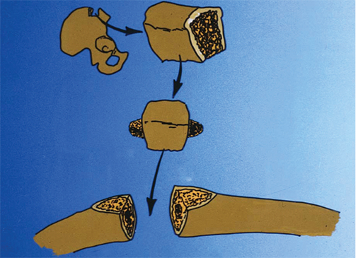 Clavicular Nonunion Figure 1
