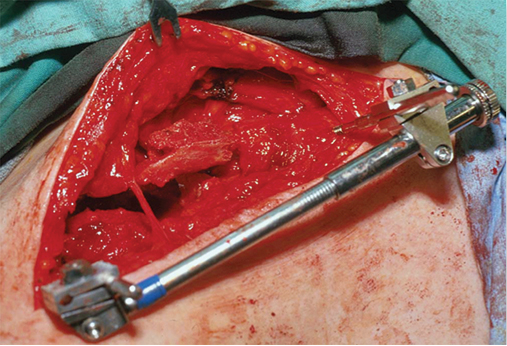 Clavicular Nonunion Figure 2