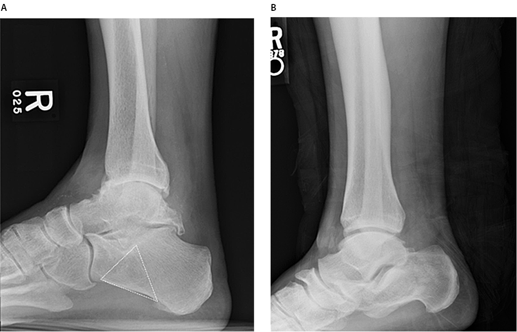 Hypodense Calcaneal Region Figure 1