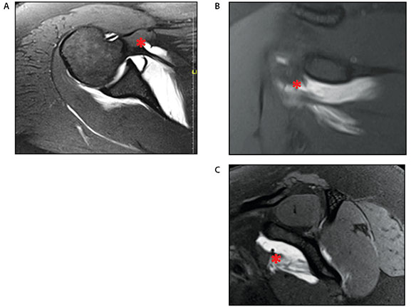 Musculotendinous Junction Tears of the Subscapularis Figure 1