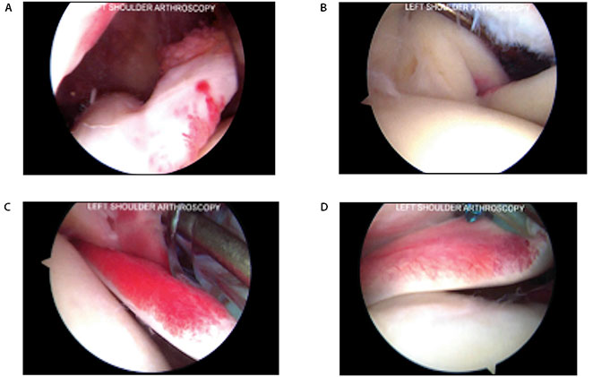 Musculotendinous Junction Tears of the Subscapularis Figure 3