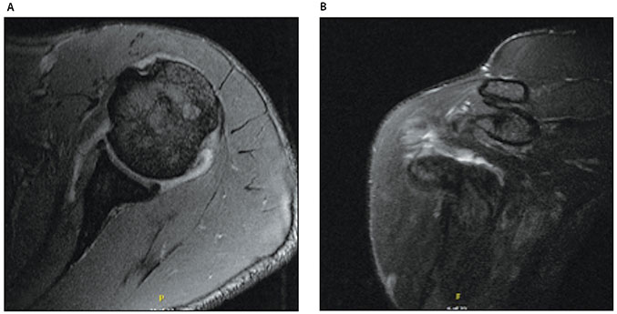 Musculotendinous Junction Tears of the Subscapularis Figure 4