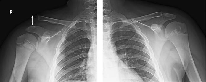 Acromioclavicular Psuedo-dislocation Figure 1