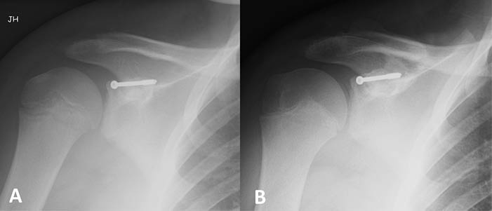 Post-op Acromioclavicular Psuedo-dislocation Figure 4