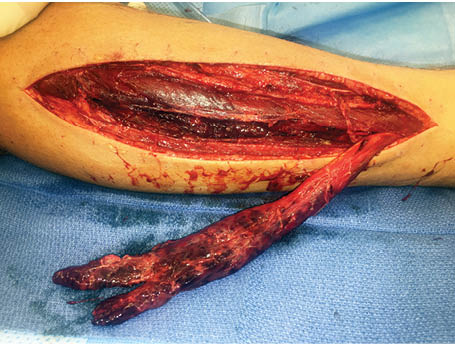 Ruptured Peroneus Longus Figure 1