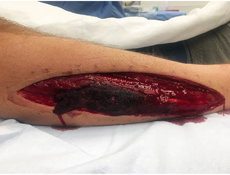 Necrotic Peroneus Longus Figure 2