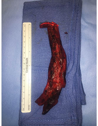 Debrided Muscle Belly Figure 3