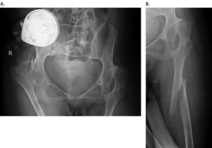 Humeral Nail Femoral Frature Figure 1