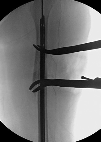 Humeral Nail Femoral Frature Figure 2